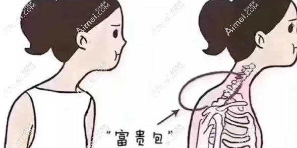 曹孟君富贵包抽脂怎样