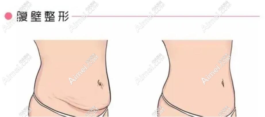 腹壁整形动画图 腹壁整形动画图