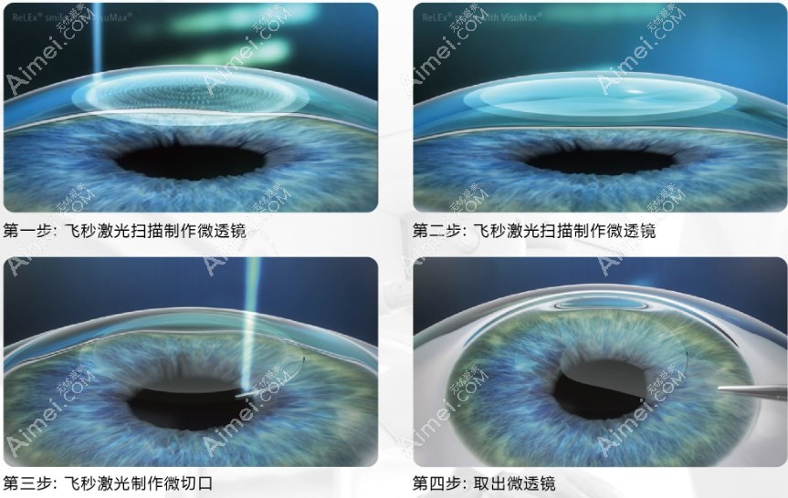 全飞秒近视手术 全飞秒近视手术