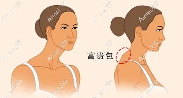 曹孟君做富贵包不会有后遗症 曹孟君做富贵包不会有后遗症