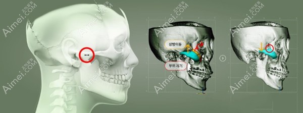 张笑天和黄大勇磨骨手术风格对比