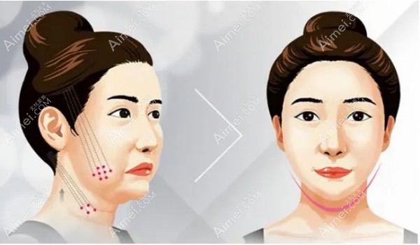 蒙喜永医生做回春术的优势 蒙喜永医生做回春术的优势
