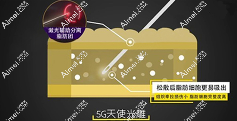 揭秘5g光雕吸脂一次能做几个部位?真实成效与范围大公开