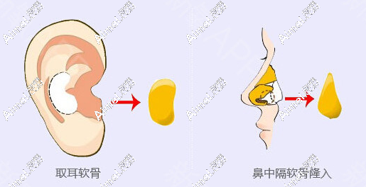 华美李任医生做自体软骨隆鼻技术好 华美李任医生做自体软骨隆鼻技术好