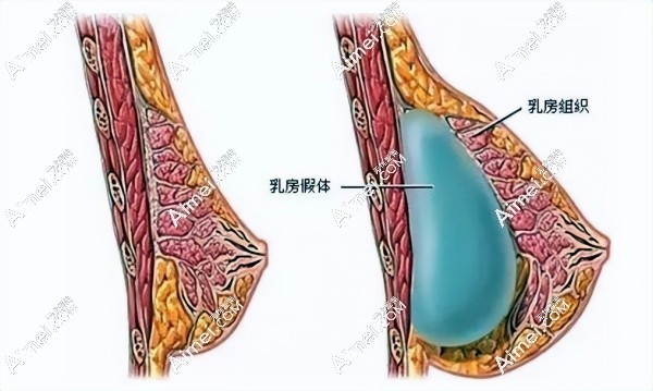 假体隆胸和自体脂肪隆胸哪个真实 假体隆胸和自体脂肪隆胸哪个真实