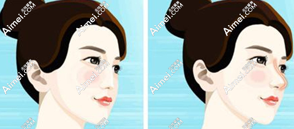 立体鼻型 立体鼻型