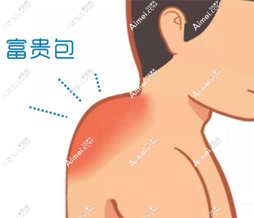北京富贵包抽脂手术多少钱