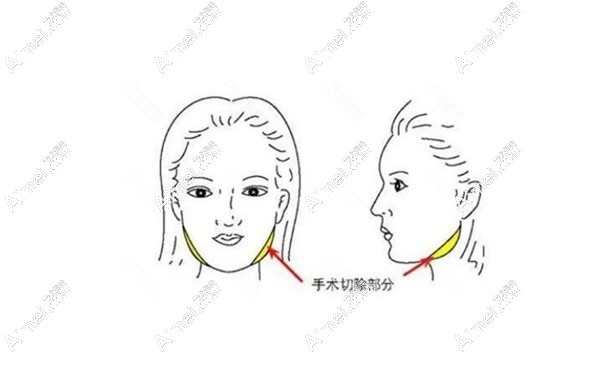 张笑天医生做下颌角/颧骨手术好aimei.com 张笑天医生做下颌角/颧骨手术好aimei.com