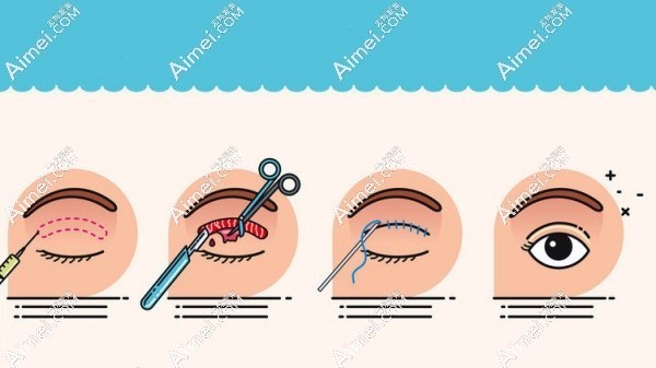 广州李光琴做双眼皮修复怎么样?听说技术靠谱口碑好,可预约