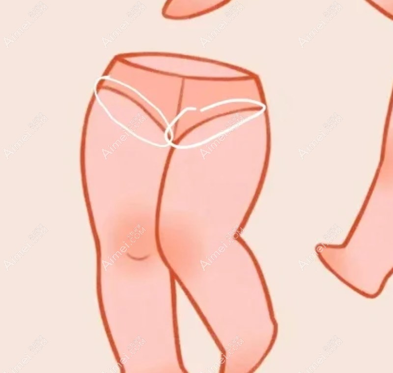 沈阳杏林整形医院吸脂 沈阳杏林整形医院吸脂