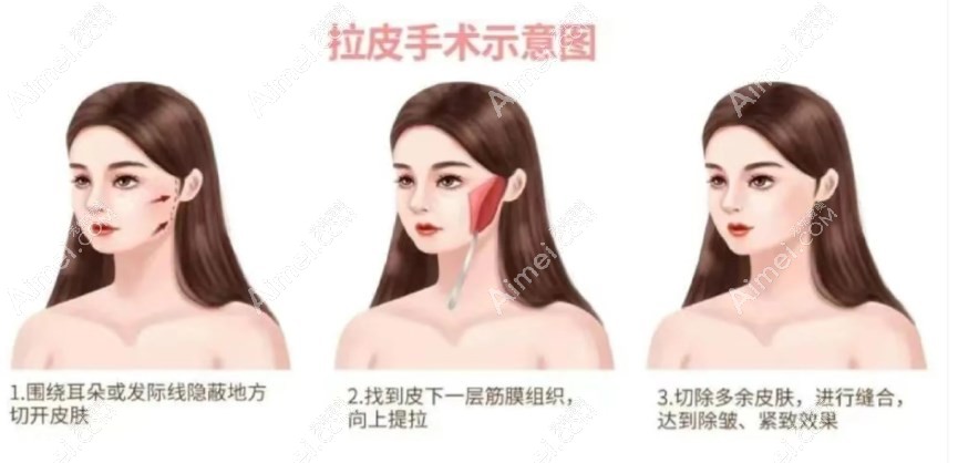 袁强拉皮手术 袁强拉皮手术