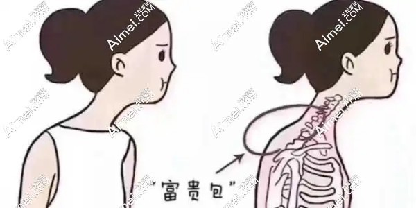 富贵包是骨头变形还是脂肪堆积