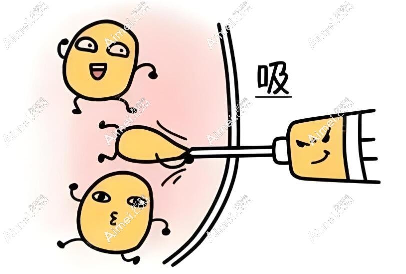 吸脂的几种方式dlren.com 吸脂的几种方式dlren.com