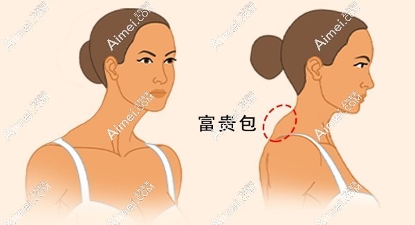 富贵包难矫正吗