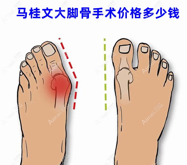 马桂文大脚骨手术价格2.8W-5.5W,透露手术医院地址及医生简介