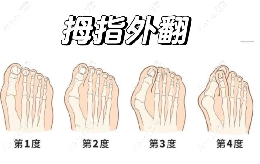 大脚骨 大脚骨