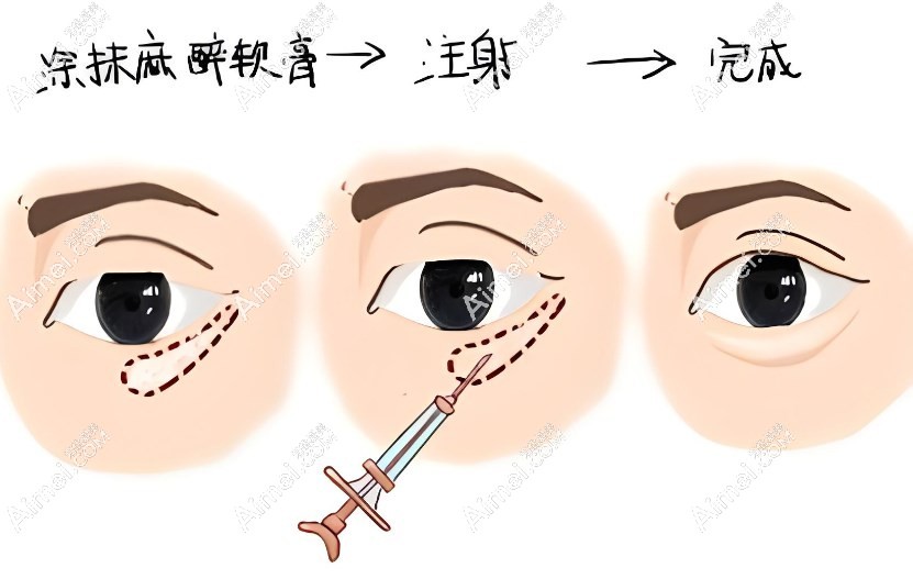 深圳艺星整形医院打玻尿酸 深圳艺星整形医院打玻尿酸