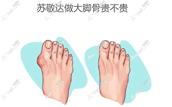 苏敬达做大脚骨贵不贵,北京圣嘉新苏敬达做拇指外翻价格12800不乱收费