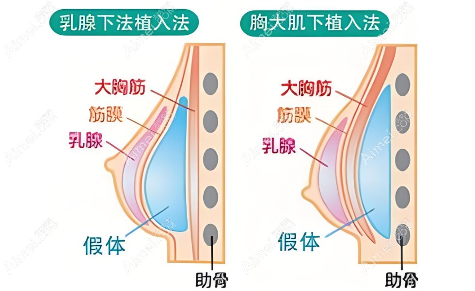 深圳做假体隆胸技术 深圳做假体隆胸技术