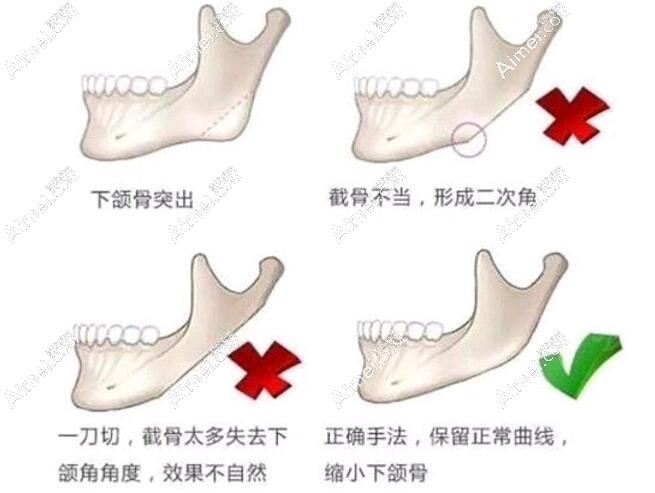 下颌角整形手术技术dlren.com 下颌角整形手术技术dlren.com
