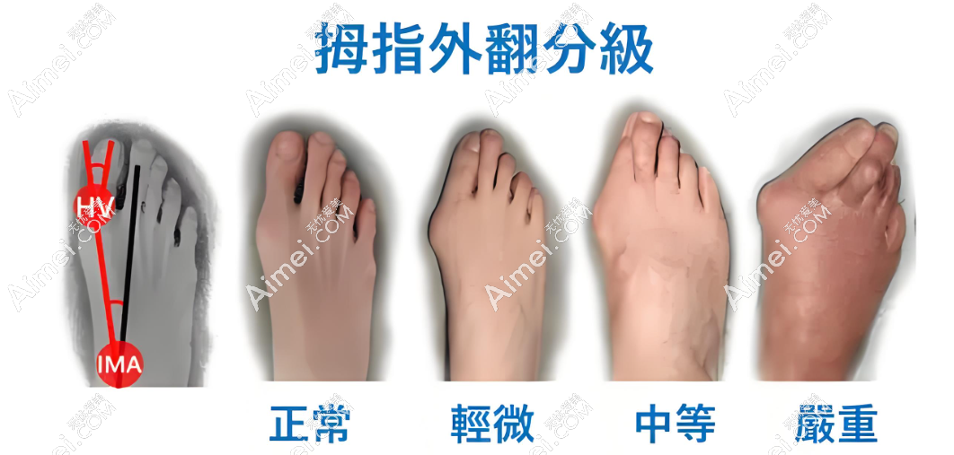 北京苏敬达拇外翻手术价格 北京苏敬达拇外翻手术价格