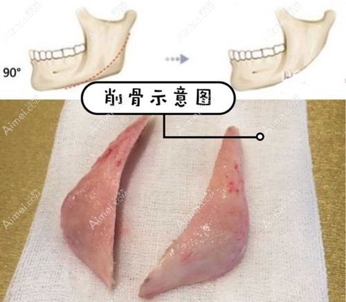 张笑天整形价格贵吗 张笑天整形价格贵吗