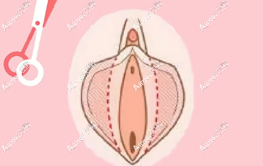 m.dlren.com 紧缩针的功效与作用:紧致阴道改善松弛,打完不会漏尿一周以上可以同房 m.dlren.com 紧缩针的功效与作用:紧致阴道改善松弛,打完不会漏尿一周以上可以同房