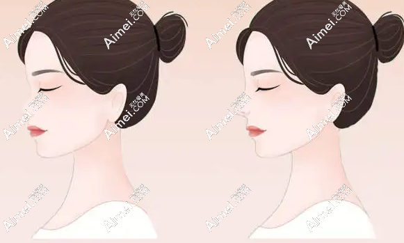 南京沈正宇专做什么项目-隆胸和鼻子,尤其是假体隆胸和鼻基底做的太惊艳 爱美网 南京沈正宇专做什么项目-隆胸和鼻子,尤其是假体隆胸和鼻基底做的太惊艳 爱美网