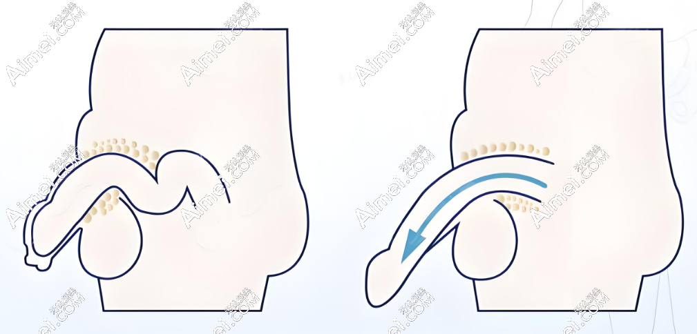 李世荣生殖器整形手术价格优惠大  m.dlren.com