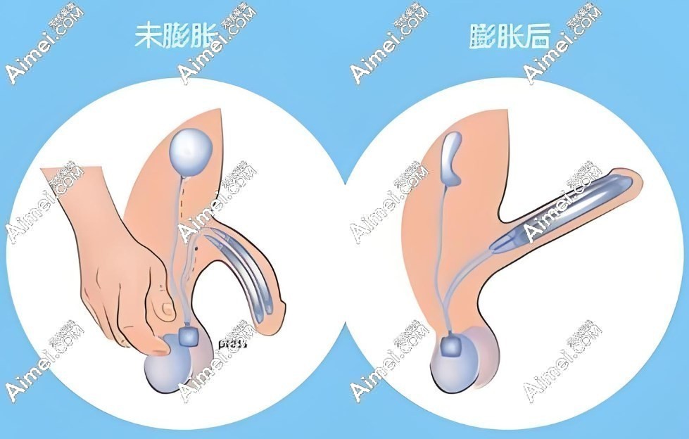 李世荣阴茎增粗延长实例对比图片 m.dlren.com 李世荣阴茎增粗延长实例对比图片 m.dlren.com