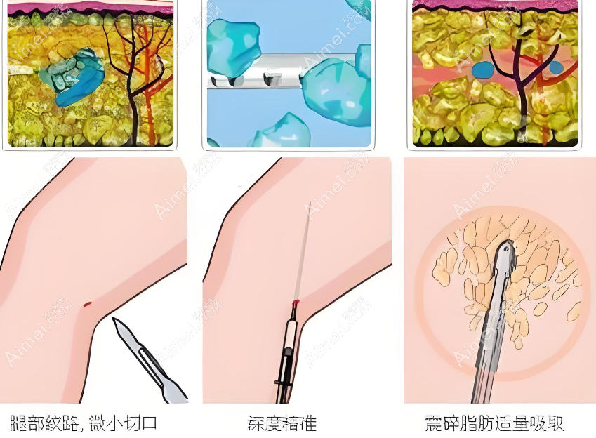 郑翔宇医生吸脂的患者评价www.dlren.com 郑翔宇医生吸脂的患者评价www.dlren.com
