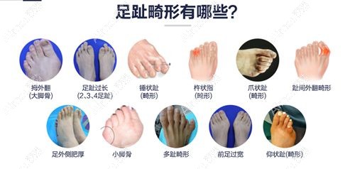 圣嘉新足雕医生靠谱 圣嘉新足雕医生靠谱