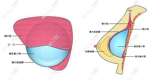 夏建军做24小时极速丰胸的手术原理 夏建军做24小时极速丰胸的手术原理