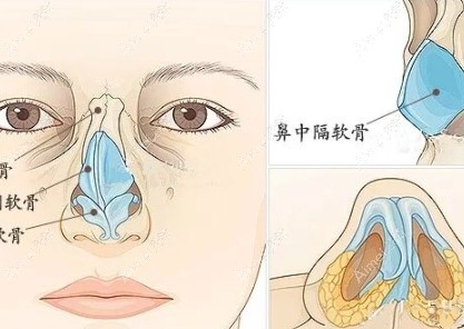 鼻整形手术 鼻整形手术