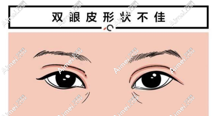 师丽丽修复内眼角实例分享(内眼角修复+眼轮匝肌对合一次修复成功)