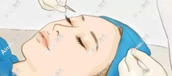 师丽丽修复内眼角实例分享(内眼角修复+眼轮匝肌对合一次修复成功） a爱美网