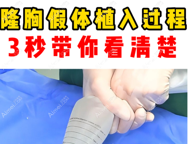 夏建军做极速丰胸采用非接触式植入假体 夏建军做极速丰胸采用非接触式植入假体