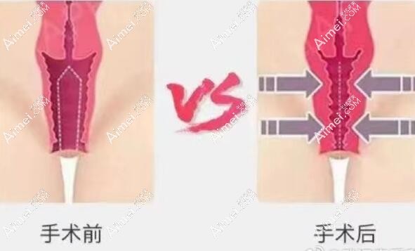 2025年东莞市做阴道紧缩术收费明细一览 2025年东莞市做阴道紧缩术收费明细一览