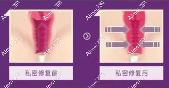 打紧缩针和做紧缩手术 打紧缩针和做紧缩手术