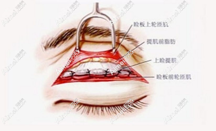 dlren.com双眼皮修复手术 dlren.com双眼皮修复手术