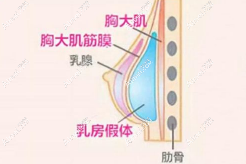 假体隆胸dlren.com 假体隆胸dlren.com