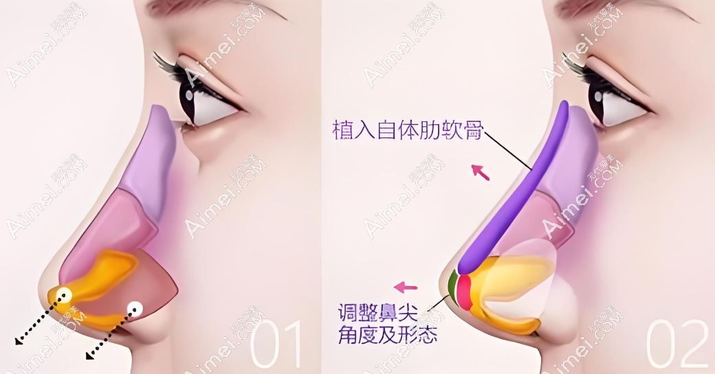 薛志强做鼻子价格参考www.dlren.com 薛志强做鼻子价格参考www.dlren.com
