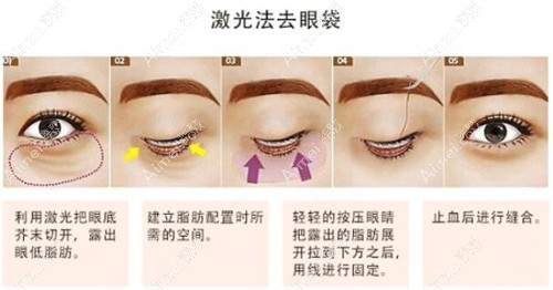 贵州割眼袋好的医院手术原理 贵州割眼袋好的医院手术原理