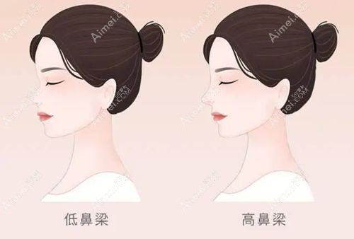 李信锋隆鼻价格表大公开!深圳千丽李信锋隆鼻费用及口碑评价请查收