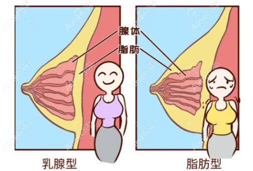 不同胸部类型 不同胸部类型