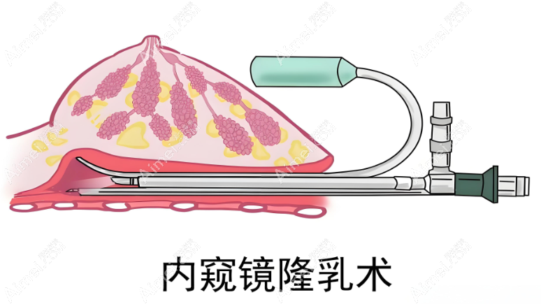 内窥镜隆胸术 内窥镜隆胸术