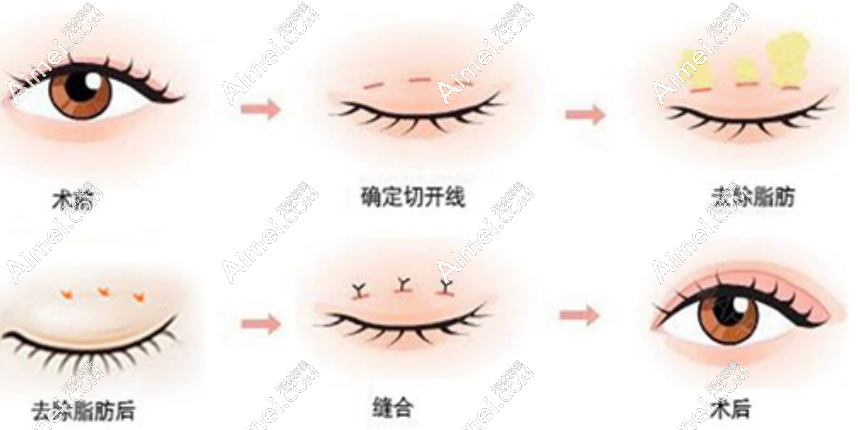 杜园园医生双眼皮修复手术 杜园园医生双眼皮修复手术