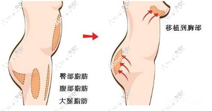 dlren.com脂肪丰胸 dlren.com脂肪丰胸