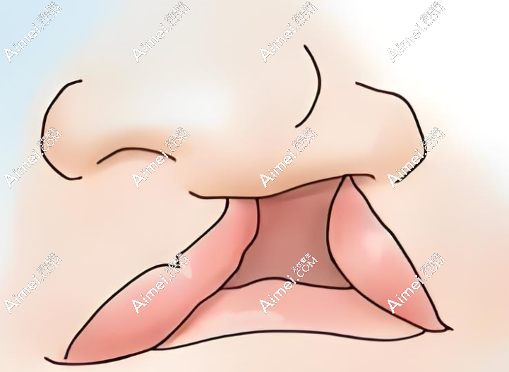 郑永生唇裂修复实例 郑永生唇裂修复实例