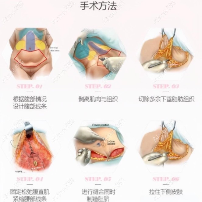 李虹医生做腹壁整形手术原理